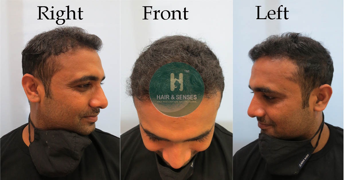 Hairline Designing 5015